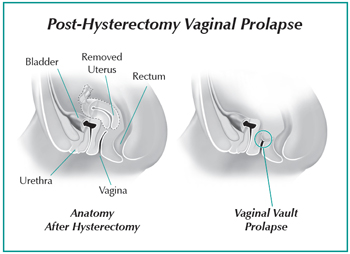 The Do's and Don'ts of Pelvic Organ Prolapse - Hudson Valley